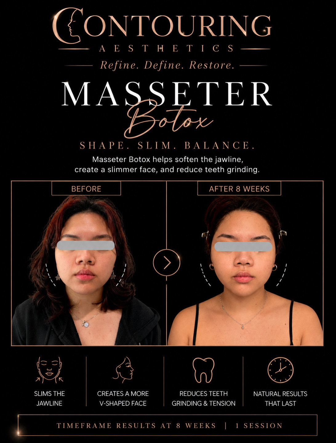 Before and after: Masseter Botox, jawline