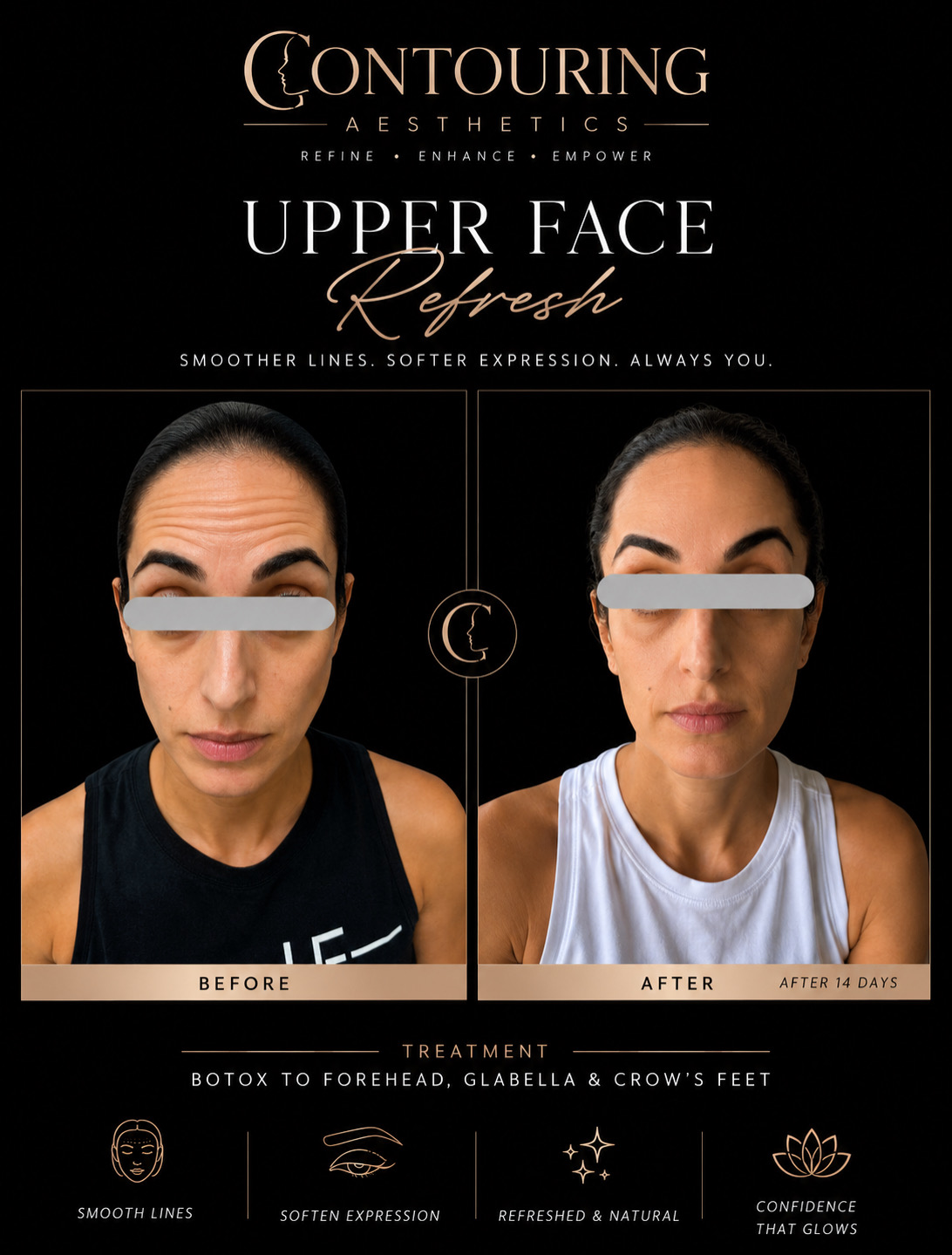 Before and after: Upper Face Refresh, botox to forehead, glabella & crow's feet
